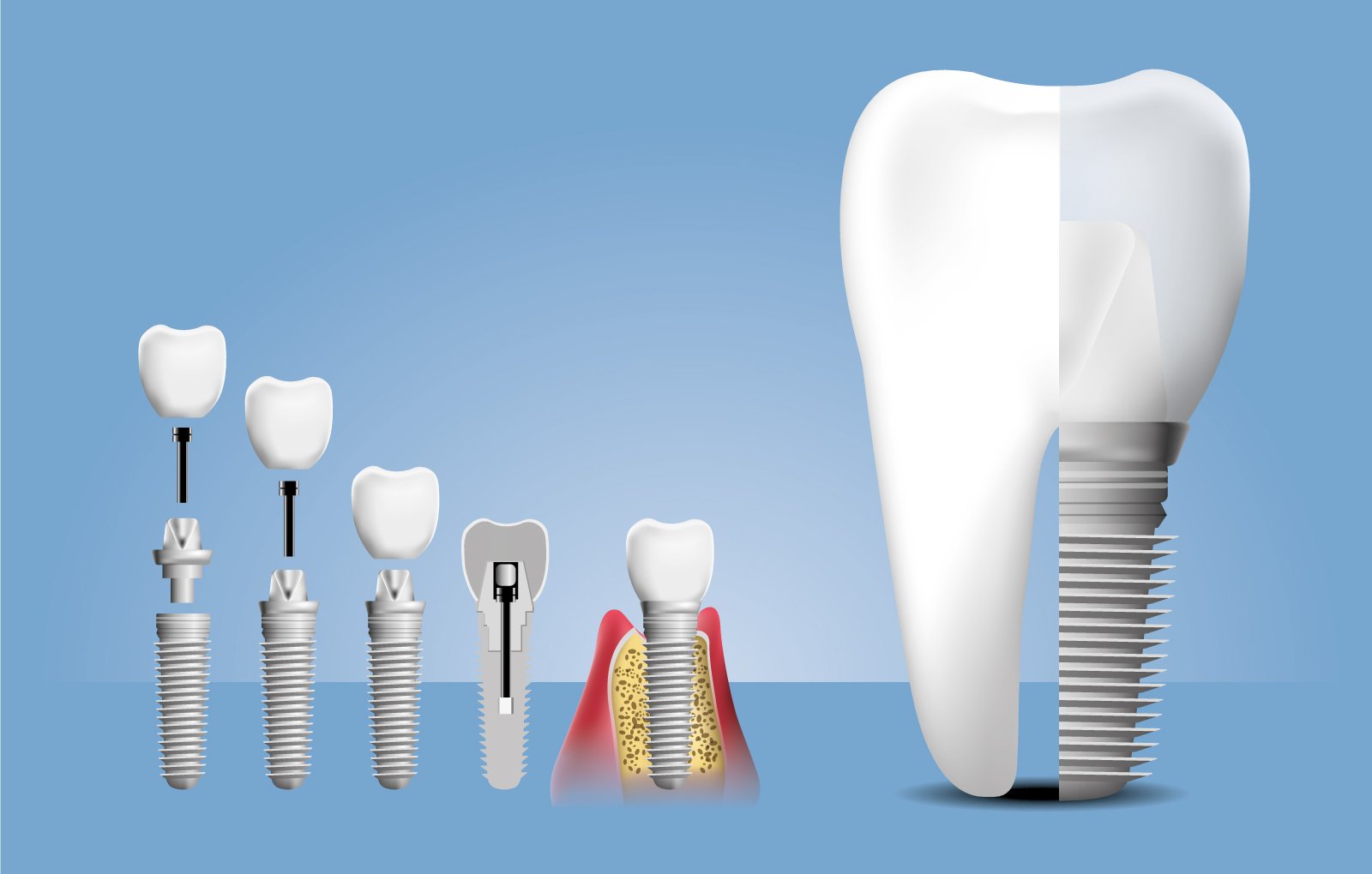 Dental Implant